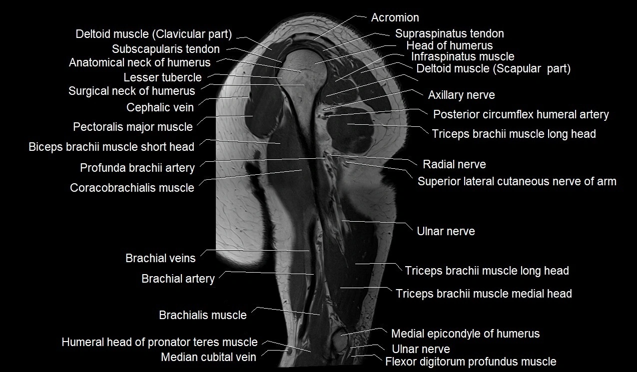 Upper arm (humerus ) saittal cross sectional anatomy 3T image 20.webp